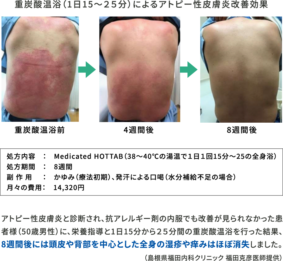 重炭酸温浴(1日15～25分)によるアトピー性皮膚炎改善効果